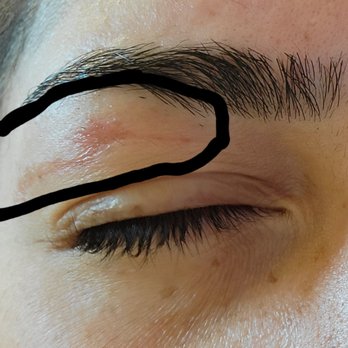 Nails For You - Next day photo of damage from waxing - Nail Salons Near Me - Concord, California