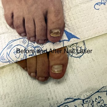Michael R. Cook, Podiatry - Before and after nail laser treatments - Podiatrists Near Me - Miami, Florida Michael R. Cook, Podiatry - Before and after nail laser treatments - Podiatrists Near Me - Miami, Florida
