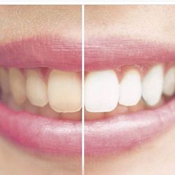 Del Dental Group - We offer 3 generation of Zoom Teeth Bleaching  systems with LED technology.