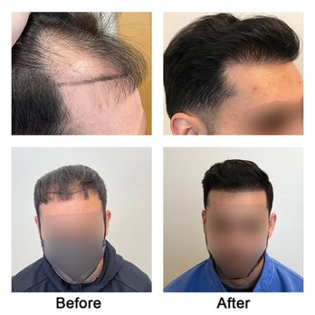AZ Hair Restoration - Before and After Photo for a real patient of AZ Hair Restoration. - Hair Loss Centers Near Me - Apex, North Carolina AZ Hair Restoration - Before and After Photo for a real patient of AZ Hair Restoration. - Hair Loss Centers Near Me - Apex, North Carolina
