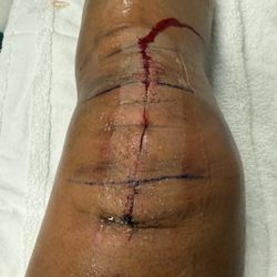 Vo Phuc MD - Open incision left unattended properly for eigjht days