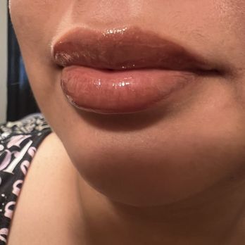 DermFx - 2 wks post filler , Restylane Define - Medical Spas Near Me - Orange, California DermFx - 2 wks post filler , Restylane Define - Medical Spas Near Me - Orange, California