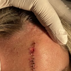 Docs Urgent Care - HIGHLY RECOMMEND! Excellent doctor with an excellent skill set! He was able to take my stitches out and correct errors the ER made!