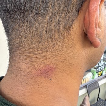 Divis Reflexology Massage and Spa - bruise on his neck after the massage - Massage Near Me - San Francisco, California Divis Reflexology Massage and Spa - bruise on his neck after the massage - Massage Near Me - San Francisco, California