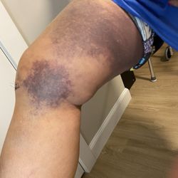CHA Cambridge Hospital - Botched surgery