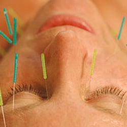 The Berkeley Clinic - acupunture