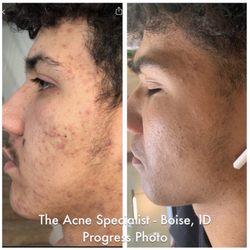 Get Clear Boise,  Acne & Anti-Aging Clinic - Before and after 8 week treatment