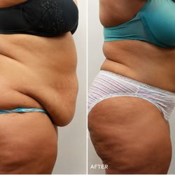 Aeris Skin & Beauty - Invisa-RED targets fat loss with 980nm laser and tightens skin with 680nm laser