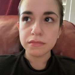 Austin D Hoover, DDS - 6 hours after, almost completely fine and without inflammation