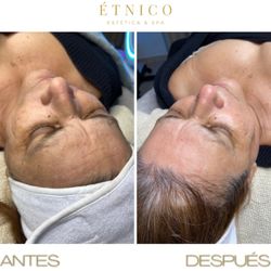 Etnico Estetica & Spa - Embark on a magical journey to youth with our radiofrequency anti-aging facial!