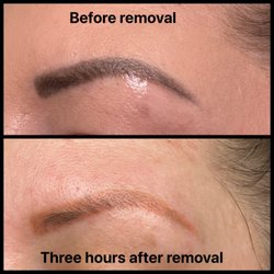 EOS Tattoo Removal