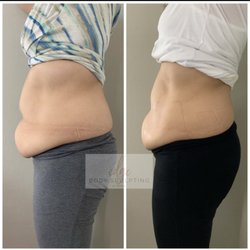 Edge Body Sculpting - My client here only did laser lipo for 45 minutes this was her 2nd session. She is very happy with her results.