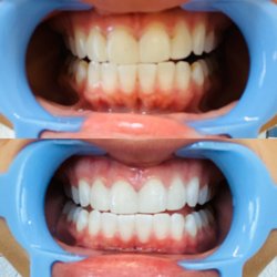 Next Level Teeth Whitening and Spray Tan - Before and after