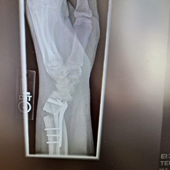 San Marcos Physical Therapy - Ostular malunion - Physical Therapy Near Me - San Marcos, California San Marcos Physical Therapy - Ostular malunion - Physical Therapy Near Me - San Marcos, California