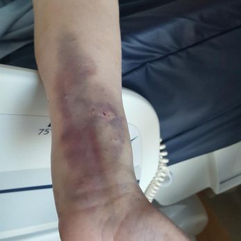 CPMC Van Ness Campus - This is her arm after they jabbed away at her to get a vein - Hospitals Near Me - San Francisco, California CPMC Van Ness Campus - This is her arm after they jabbed away at her to get a vein - Hospitals Near Me - San Francisco, California