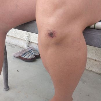 Northridge Service Inc - Scab on my wife's knee - Auto Repair Near Me - Chatsworth, California Northridge Service Inc - Scab on my wife's knee - Auto Repair Near Me - Chatsworth, California