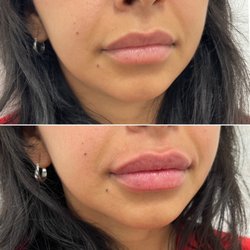 Taren Nicole Aesthetics - Lip Filler