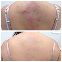 Corrective Skincare - Before- my first appointment After- 3 months later with regular appointments and following my at home care religiously. AMAZING