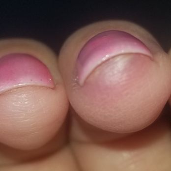 BCBC Nails Spa - Painful infection - Nail Salons Near Me - Calabasas, California BCBC Nails Spa - Painful infection - Nail Salons Near Me - Calabasas, California