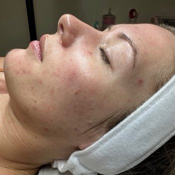 Skin Journey - Starting point - Acne Treatment Near Me - Scottsdale, Arizona Skin Journey - Starting point - Acne Treatment Near Me - Scottsdale, Arizona