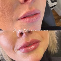 Ageless Medical Spa - Ageless Lip Filler Results