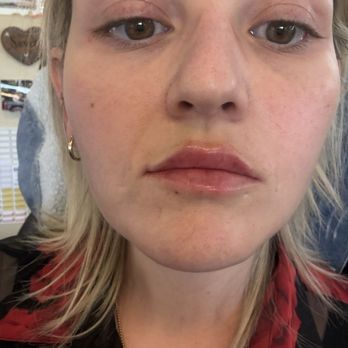 NAKEDMD - Carlsbad - Look at all the bruises and how lop sided they did my lips .... Terrible ! - Medical Spas Near Me - Carlsbad, California