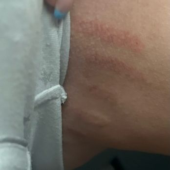New Age Aesthetics & Wellness - Laser burn mark - Medical Spas Near Me - Centennial, Colorado New Age Aesthetics & Wellness - Laser burn mark - Medical Spas Near Me - Centennial, Colorado
