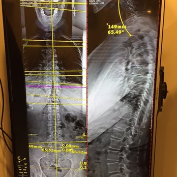 Intero Chiropractic - In depth x-ray from 2 directions of my spine. - Chiropractors Near Me - Pleasanton, California Intero Chiropractic - In depth x-ray from 2 directions of my spine. - Chiropractors Near Me - Pleasanton, California