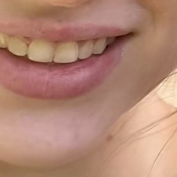 Kotch Dental - Photo after the chip was fixed, and you can see discoloration and unevenness still - General Dentistry Near Me - Pembroke Pines, Florida
