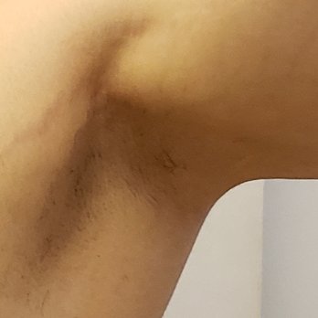 The Ferguson Clinic - Right underarm. 3 weeks post first hair removal - Cosmetic Surgeons Near Me - Honolulu, Hawaii The Ferguson Clinic - Right underarm. 3 weeks post first hair removal - Cosmetic Surgeons Near Me - Honolulu, Hawaii