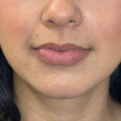 Kiss & Tell Aesthetics - Before lip filler and masseter botox
