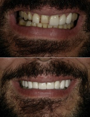 Veneer preparations - Patient broken veneer and here's patient after veneer was fixed Veneer preparations - Patient broken veneer and here's patient after veneer was fixed