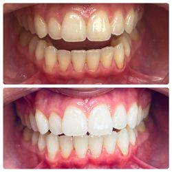 Kamie’s Beauty Bar - Teeth whitening with LED light.