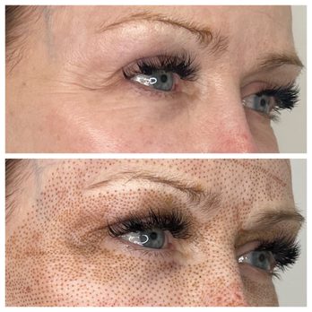 Plasma Babe - Non surgical eye lift - Skin Care Near Me - Los Angeles, California