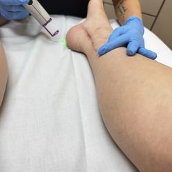 Ringpfeil Advanced Dermatology - Scar Laser Treatment
