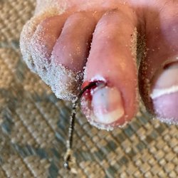 Southern Urgent Care - Fishing hook impaled under toe nail on 7/31