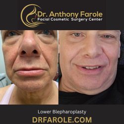 Anthony Farole, DMD - Lower Lid Blepharoplasty before and six weeks post op