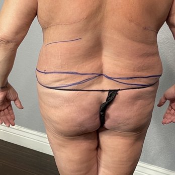 New Elite Aesthetics - Pre Upper and lower Back lipo - Medical Spas Near Me - Granite Bay, California