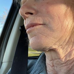 Robert Cristel, MD: Synergi Facial Surgery - Before