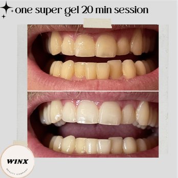 Bronze & Honey - Before & after teeth whitening - single session - Spray Tanning Near Me Bronze & Honey - Before & after teeth whitening - single session - Spray Tanning Near Me