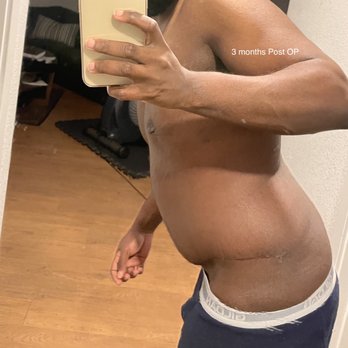 Korman Plastic Surgery & Wunderbar MedSpa - Does it look like I had a tummy tuck with this much laxity still left? - Cosmetic Surgeons Near Me - Mountain View, California