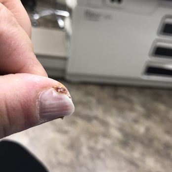 Allure Nails & Spa - At urgent care again. Pain is pretty unbearable - Nail Salons Near Me - Beaverton, Oregon Allure Nails & Spa - At urgent care again. Pain is pretty unbearable - Nail Salons Near Me - Beaverton, Oregon