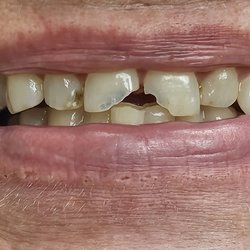 Adult Dentistry - Before the Snap on smile