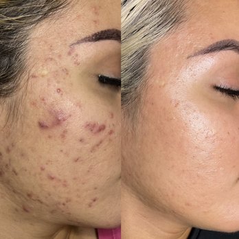 Beautopia Skin Studio - B/A acne program - Medical Spas Near Me - Houston, Texas