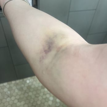 Ace Dental Center - The missed vein that resulted in me getting fentanyl injected into my arm rather than the vein - Oral Surgeons Near Me - Lombard, Illinois