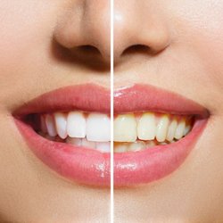 Henry L Mason, DMD - Smile Today Dentistry - Before: Yellow spot on bottom front tooth on right. After: Left photo is after Smile Today visit.