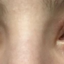I had an allergic reaction to extensions at Lust For Lashes & Michelle refused to refund my money. Anyone is at risk of a reaction. Beware. I had an allergic reaction to extensions at Lust For Lashes & Michelle refused to refund my money. Anyone is at risk of a reaction. Beware.