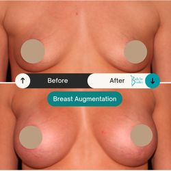 Timothy Bradley, MD - Before & After Breast Augmentation