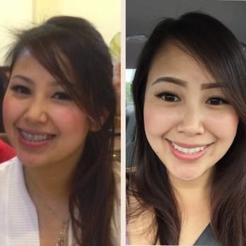 Farina Orthodontic Specialists - New Tampa - Before and after braces. I couldn't contain my excitement and took a picture post-braces right outside the office :D - Orthodontists Near Me - Tampa, Florida Farina Orthodontic Specialists - New Tampa - Before and after braces. I couldn't contain my excitement and took a picture post-braces right outside the office :D - Orthodontists Near Me - Tampa, Florida