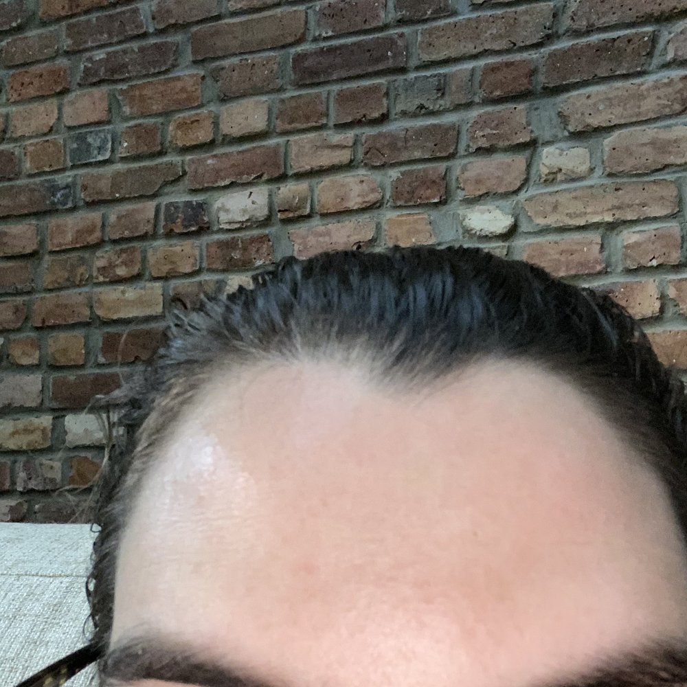 Forehead after 5 + days Forehead after 5 + days